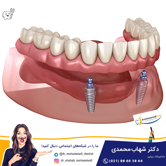 اوردنچر